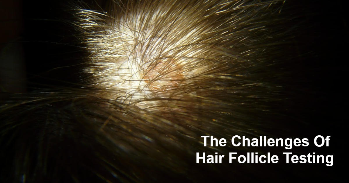 The Challenges Of Hair Follicle Testing